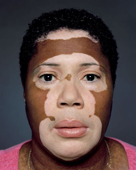 Diseased Skin Vertiligo Vitiligo Is A Condition In Which Areas Of
