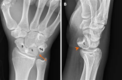 Lunate Dislocation With Avulsed Triquetral Fracture A Case Report