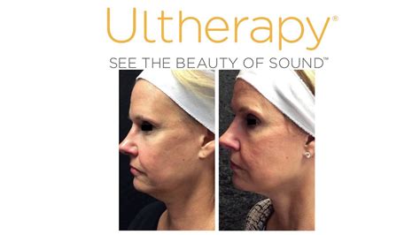 Ultherapy Décolletage Face Or Neck Lift Without Surgery Youtube