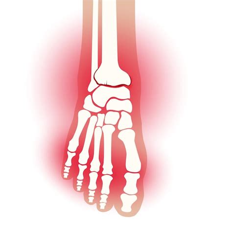 Premium Vector Arthritis Foot Joint Rheumatoid Pain In Leg Flat