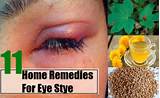 Home Remedies Eye Stye Pictures