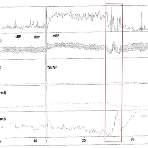 Hemodynamic Parameters During Head Up Tilt Table Test Were Obtained