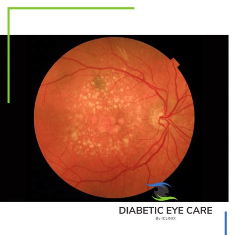 Age Related Macular Degeneration Diabetes Eye Care