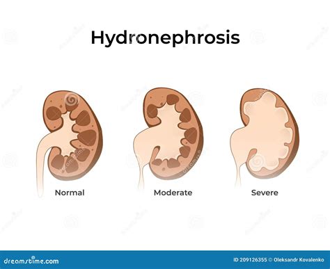 Normal Kidney With Hydronephrosis Vector Illustration Of The Of The