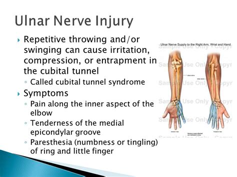 Ulnar Nerve Injury Paces