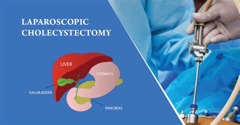 Laparoscopic Cholecystectomy Gallbladder Surgery Kochi Lakeshore