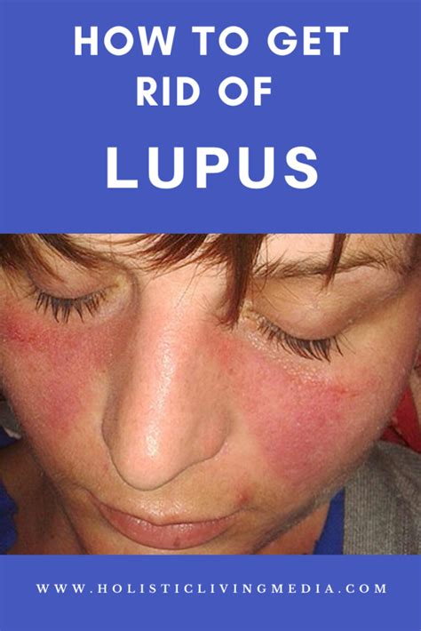 How To Get Rid Of Lupus Chronic Inflammation Natural Remedies For