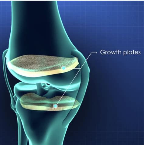 Growth Plate Injuries Treatment At Cure 4 The Kids Foundation