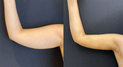Before And After Arms Liposuction Neinstein Plastic Surgery