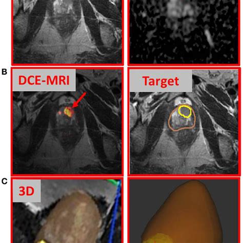 Multiparametric Mri Findings And Directed Prostate Biopsy Of The Index