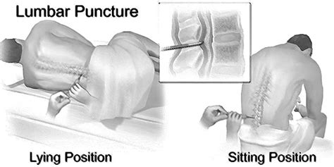 Anatomy For Lumbar Puncture
