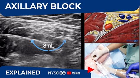 Ultrasound Guided Axillary Brachial Plexus Nerve Block Nysora