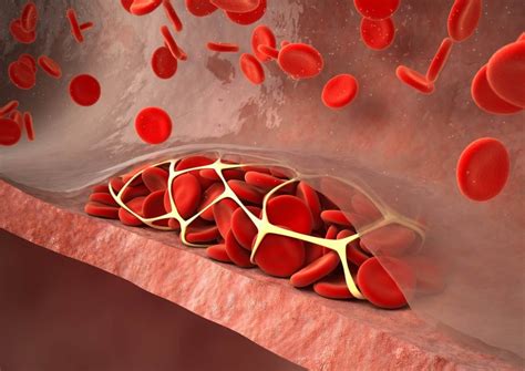 Direct Oral Anticoagulant Therapy Noninferior To Lmwh In Preventing