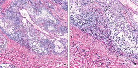 Eosinophilic Pustular Folliculitis With Underlying Mantle Cell Lymphoma