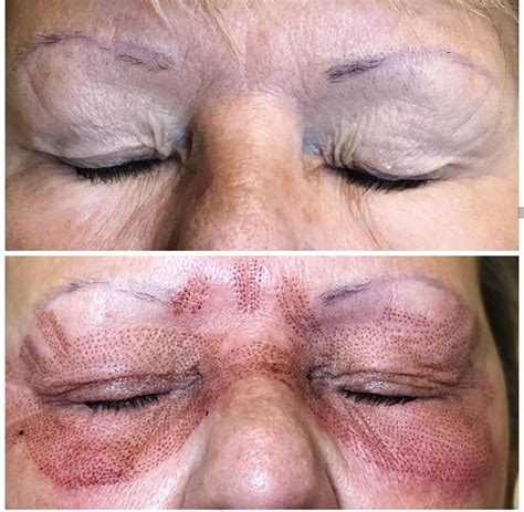 Fibroblast Plasma Skin Tightening Treatment North Carolina — Izar