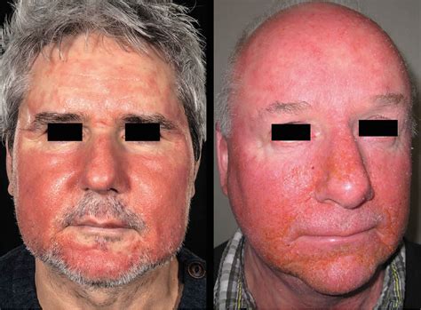 Dermatitis Rash On Face