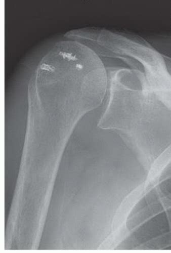 Surgical Revision For Failed Rotator Cuff Surgery Musculoskeletal Key