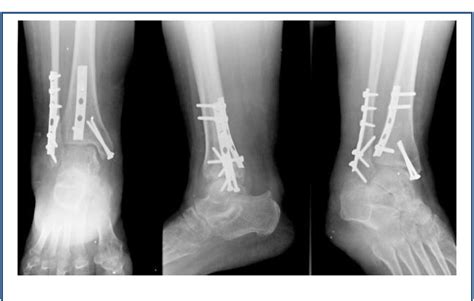 Pdf Plate Fixation Of Posterior Malleolar Fractures Through My Xxx Hot Girl