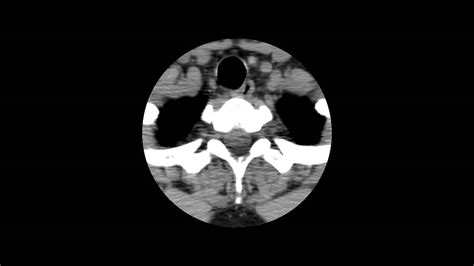 Neck Cat Ct Scan Youtube