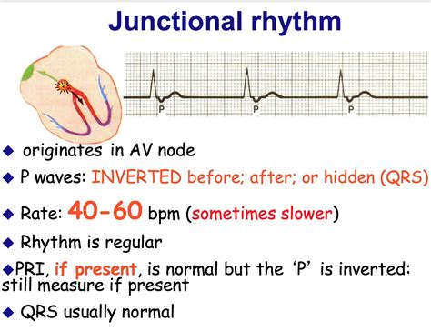 Junctional Rhythms