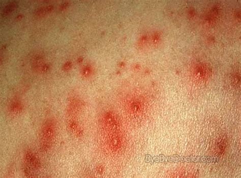 Hot Tub Rash Pictures Symptoms Treatment Cure Causes Remedy