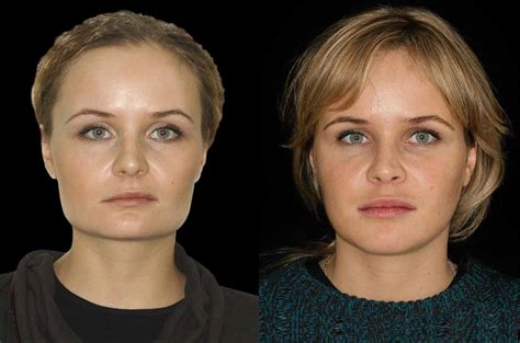 Orthognathic Facial Asymmetry Correction Orthognathic Surgery