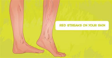 How To Recognize A Blood Clot 6 Tell Tale Symptoms