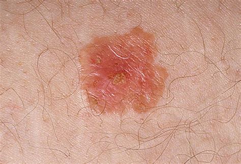 Pictures Of Skin Cancer Beginning Stages Of Skin Cancer