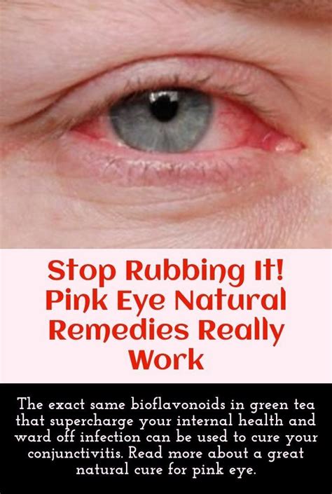 Pin By Michelle Crabtree Gibson On Remedies Natural Pink Eye Remedy