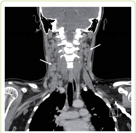 Computed Tomography Of The Neck Shows Multiple Enlarged Lymph Nodes On