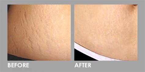 Fractional Co2 Laser For Stretch Mark Treatment Premier Clinic