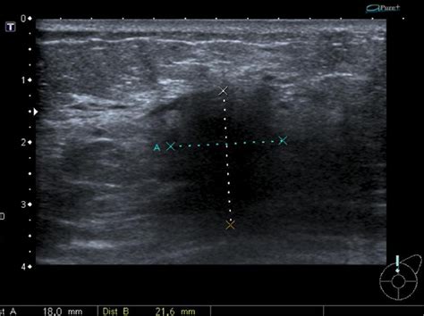 Figure 1 From Ultrasound Of Non Neoplastic Breast Lesions With