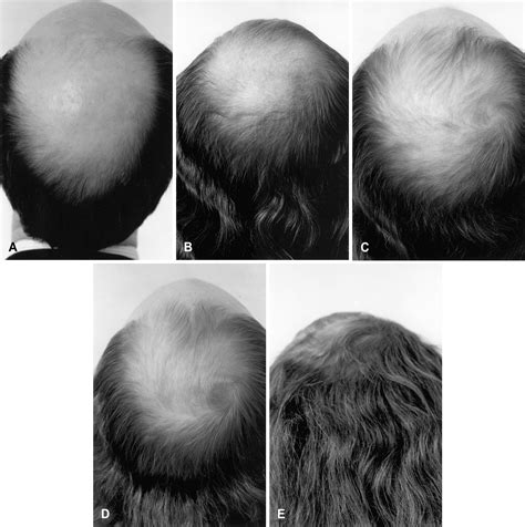 Spironolactone Hair Growth Innovative Use Of Spironolactone As An