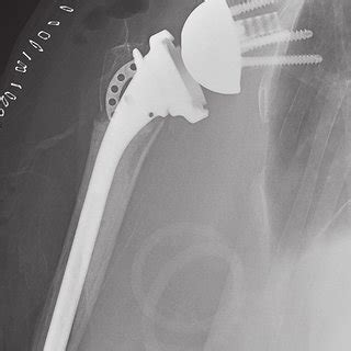 —A 3-part proximal humerus fracture (A) with a displaced ...