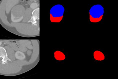 Figure 3 From Kidney Tumor Segmentation Using Dual Fully Convolutional