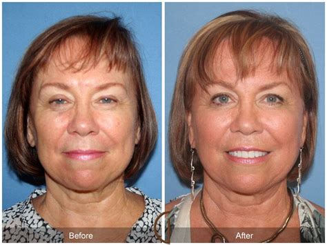 Facial Fat Grafting Before And After Photos Patient 11 Dr Kevin Sadati