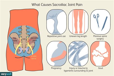 Sacroiliac Joint Pain Symptoms Causes And Treatment