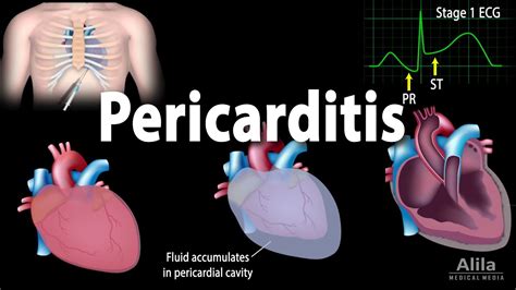 Pericarditis Symptoms Pathophysiology Causes Diagnosis And Treatments Animation Youtube