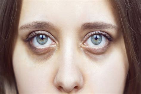 Swelling Around Eyes Anaemia Could Be Signs Of Kidney Malfunction Kgmu