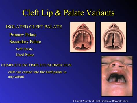 Clinical Aspects Of Cleft Lip And Palate Reconstruction