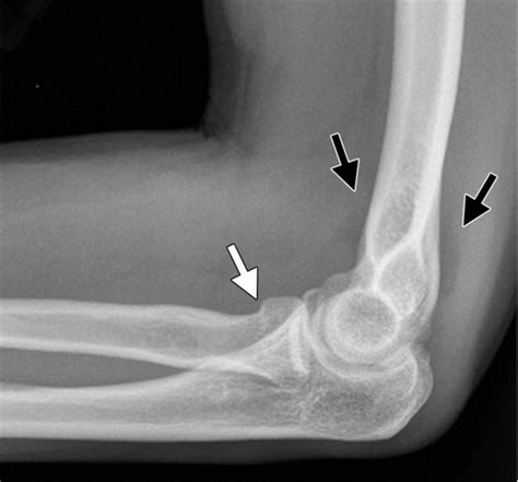 Traumatic Elbow Injuries What The Orthopedic Surgeon Wants To Know