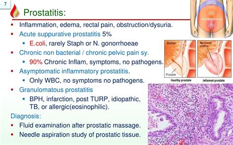 Ppt Pathology Of Prostate Benign Powerpoint Presentation Free Download Id