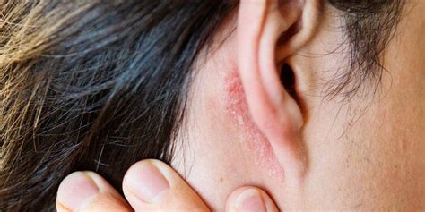Fungal Ear Infection Symptoms And 4 Best Treatment Options