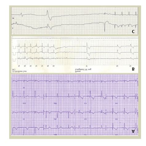 A Baseline Ecg Showing Sinus Rhythm With Prolonged Pr Interval B And