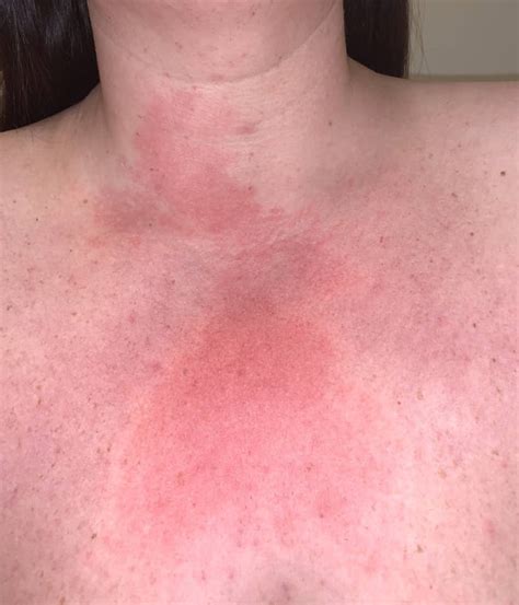 Skin Reaction On My Chestneck Any Of You Guys Have Reactions Like