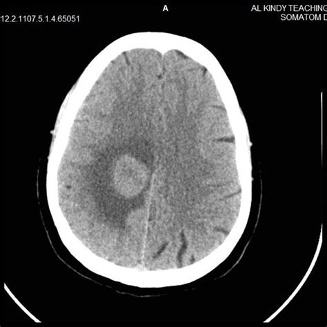 Ct Scan Image Of Brain Tumor Download Scientific Diagram