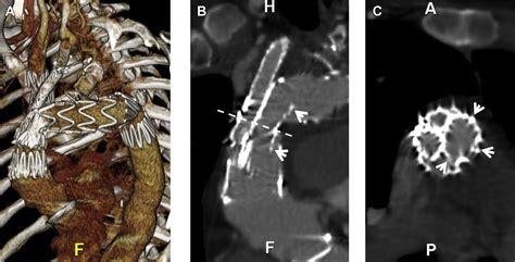 Iatrogenic Coarctation Caused By Branched Thoracic Endovascular Aortic