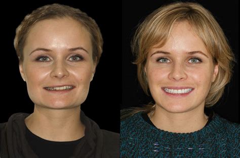 Orthognathic Facial Asymmetry Correction Corrective Jaw Surgery Dr
