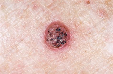 Keratoacanthoma Nodule On The Skin Stock Image C0044236 Science