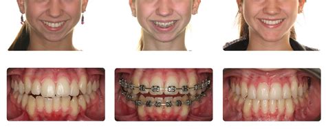 Orthognathic Jaw Surgery Before And After Doctor Emma